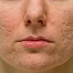 Options for Treating and Preventing Acne Scarring